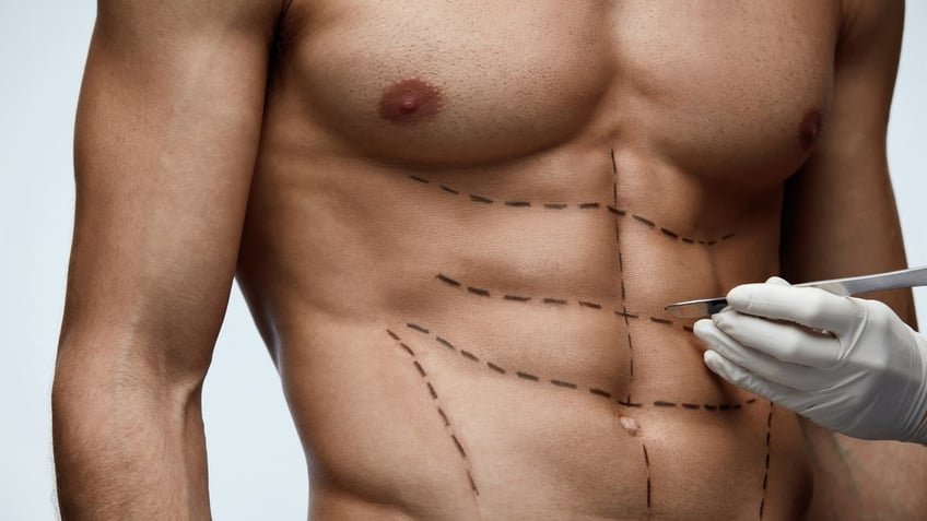 Six-pack surgery