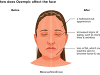 Skincare Firm Vows To Rid 'Ozempic Face' In New Marketing Push 