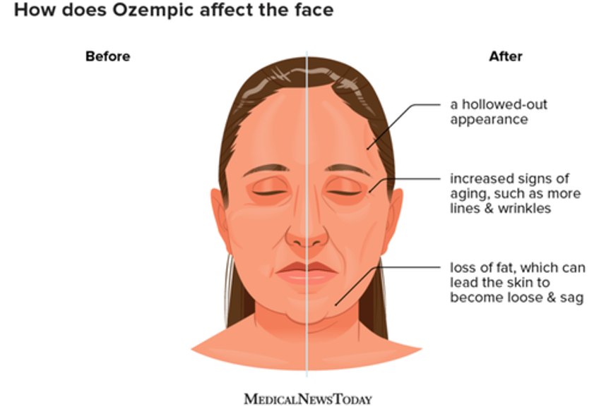 skincare firm vows to rid ozempic face in new marketing push 