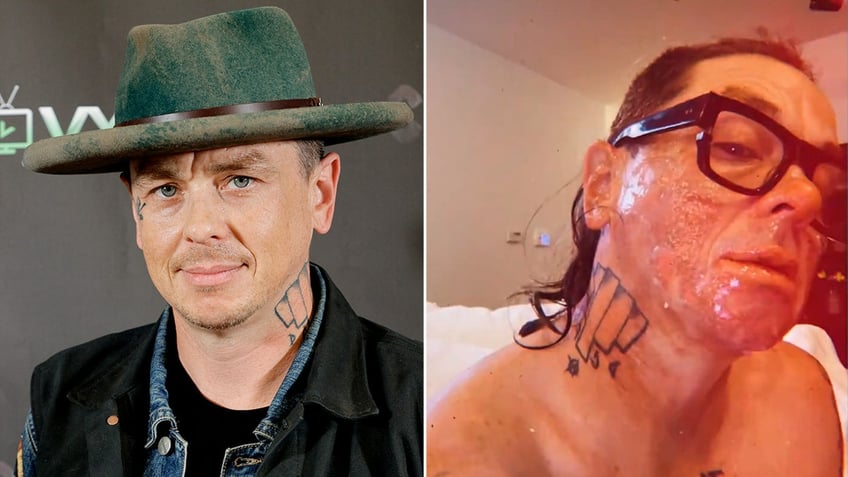 Side by side photos of Sid Wilson on the red carpet and showcasing his facial burns on Instagram