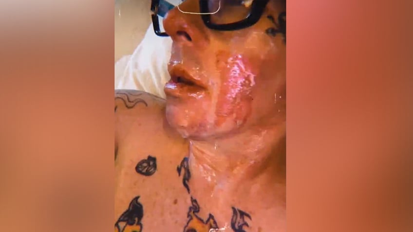 Close up of Sid Wilson's burned face