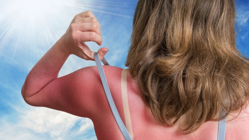 Woman with sunburn