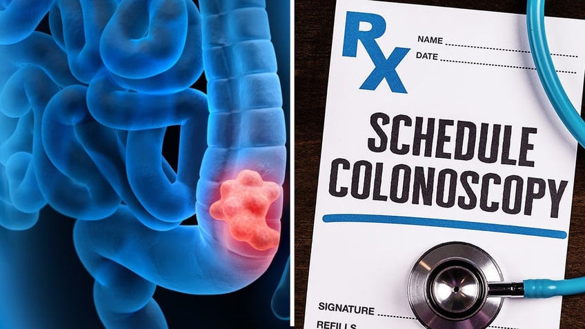 split/colonoscopy