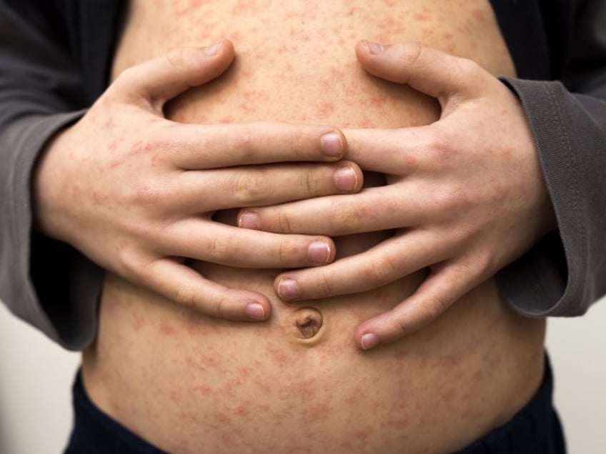 Measles infection (iStock / Getty Images Plus)