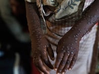 Third of Burundi mpox cases in children under five: UN