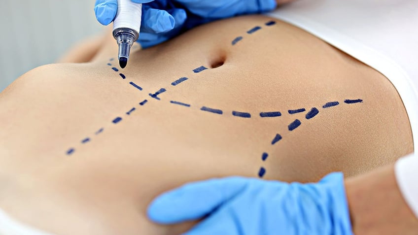 plastic surgeon drawing preoperative markings on skin of patient's abdomen