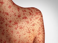 Traveler infected with confirmed case of measles at Seattle International Airport as cases in US increase