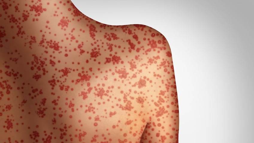 an artist's rendering of a measles rash