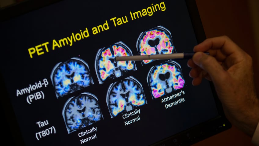 PET scan results