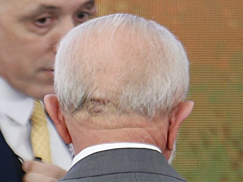 Detail view of the stitched wound of President of Brazil Luiz Inácio Lula da Silva during