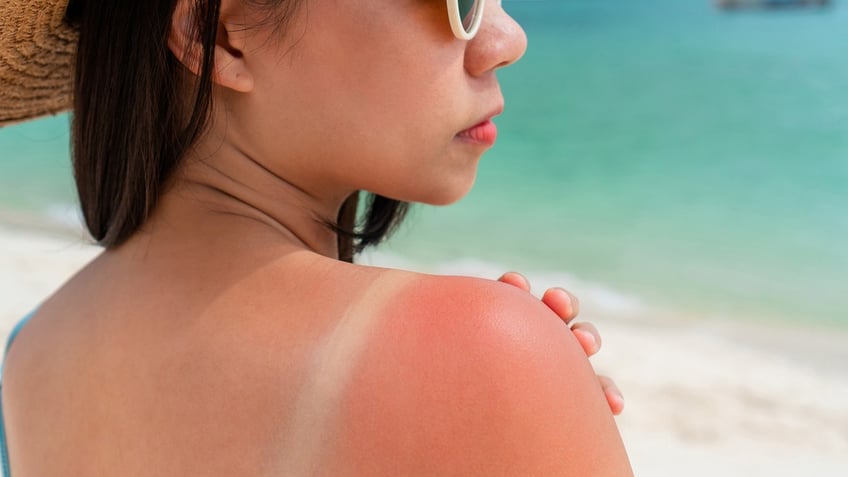 Woman with sunburn