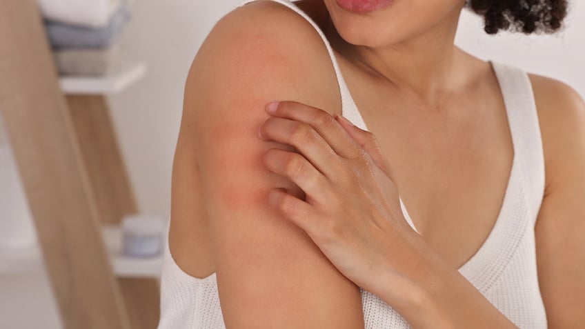 what is eczema causes symptoms and how to treat the skin condition