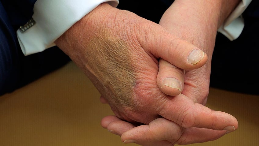 Bruise on Trump's hand