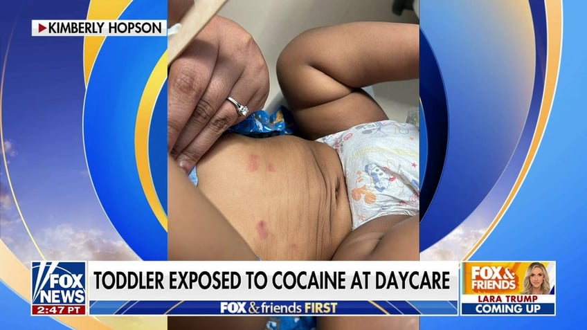 Wisconsin toddler marks on body