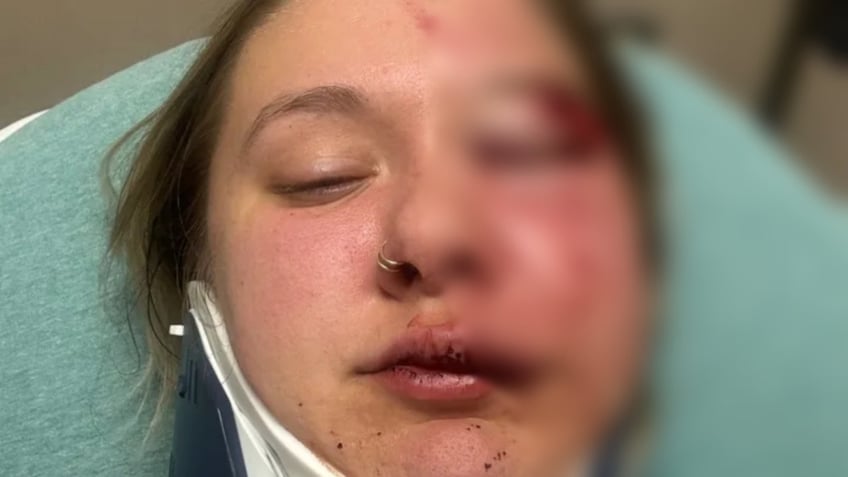 A photo of Morgan Catton's injured face