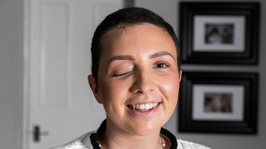 A young woman, Olivia Corbiere, smiling into the camera, one of her eyes is shut due to an accident she suffered skiing in Bulgaria.